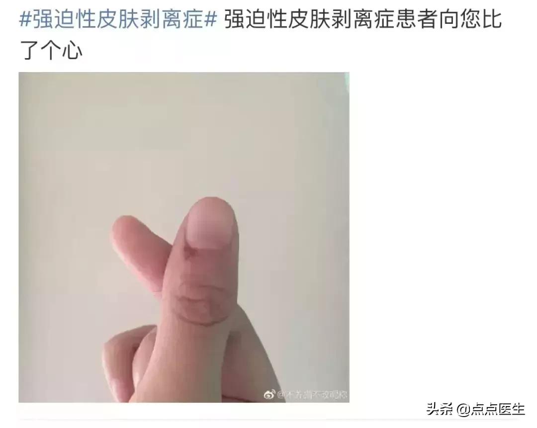 爱拔倒刺是心理疾病么,喜欢拔倒刺属于心理行为问题吗