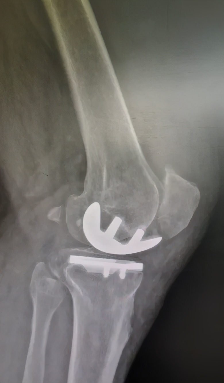 膝关节痛风肿胀疼痛怎么办,膝关节肿胀是痛风吗