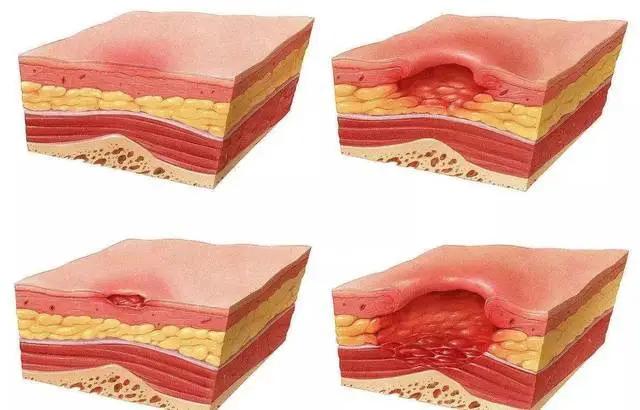 老年人的褥疮是什么样,褥疮病的鉴别诊断