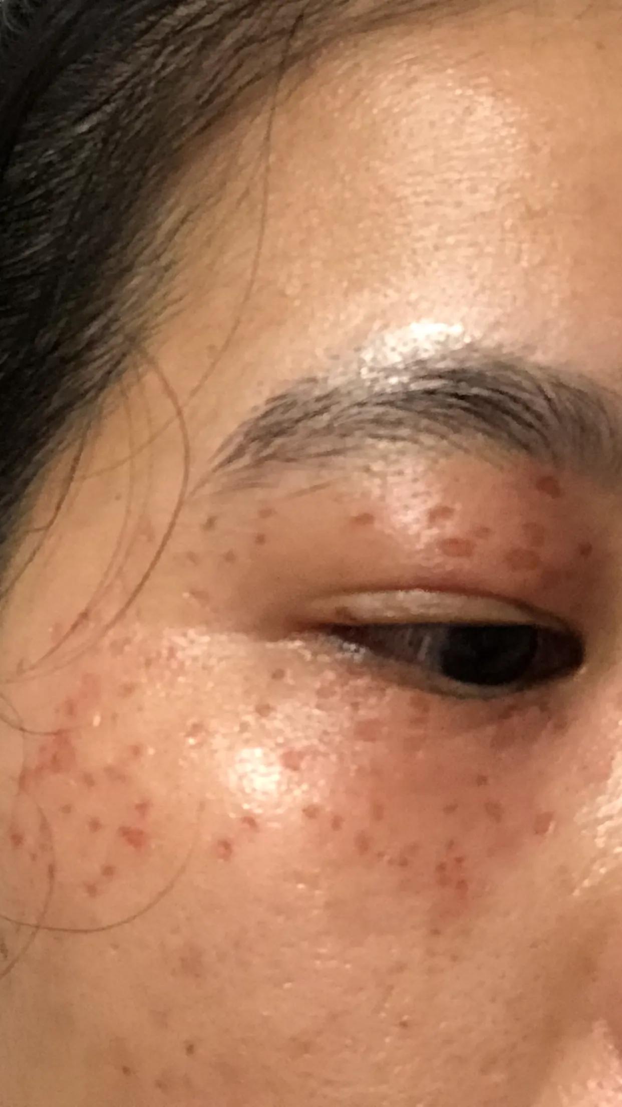 脂肪粒最好的处理方式,脂肪粒的正确处理方法