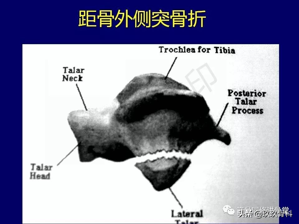 距骨骨折后遗症,距骨骨折怎么办