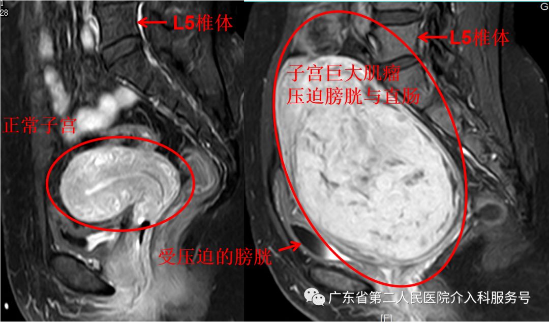 子宫肌瘤引起“大姨妈”排山倒海，淋沥不净……针眼妙方解除烦恼