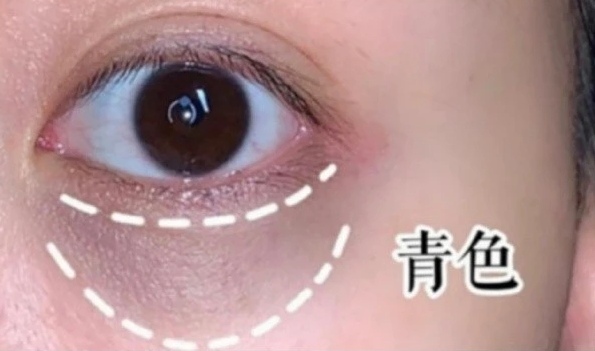 长了黑眼圈怎么办,没熬夜为什么长黑眼圈