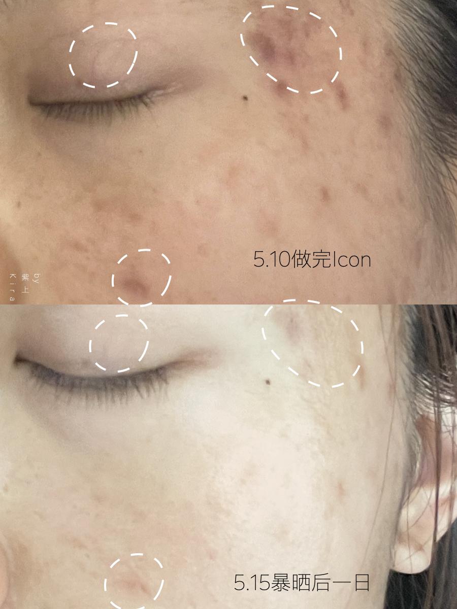 为了亲眼看到龚俊我的脸差点毁了,做了光子嫩肤,护理必须要上心