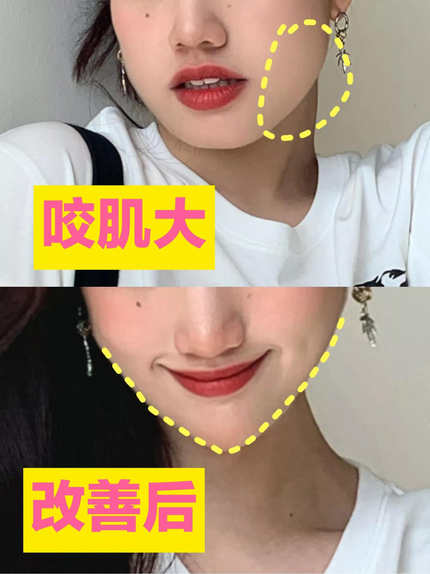 瘦咬肌操能瘦脸上的肉吗,瘦脸按摩可以瘦咬肌吗