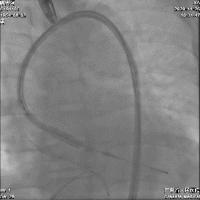 微创人工主动脉瓣膜置换术,微创介入主动脉瓣膜置换术