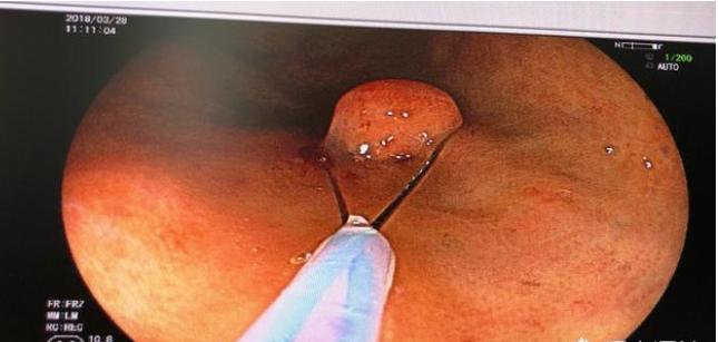 普通肠镜要是有息肉直接切除痛吗,肠镜有痛可以做切除息肉吗