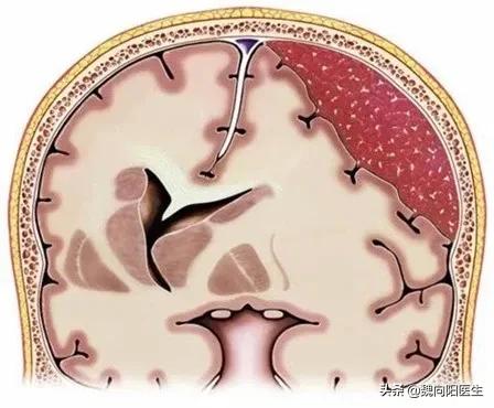 老年痴呆引起双腿无力怎么治疗,老年痴呆伴有精神症状还能治疗吗