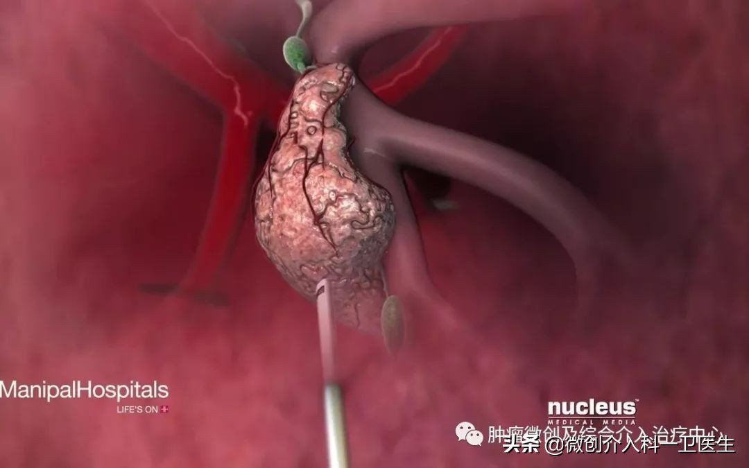 运城市第一医院肿瘤微创及综合介入科，特色技术—肿瘤穿刺活检术