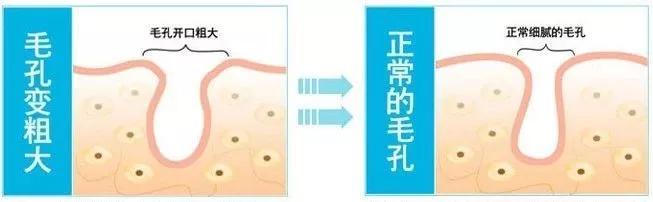 挤压导致的毛孔粗大是不可逆的吗,挤黑头后的毛孔粗大是不可逆的吗