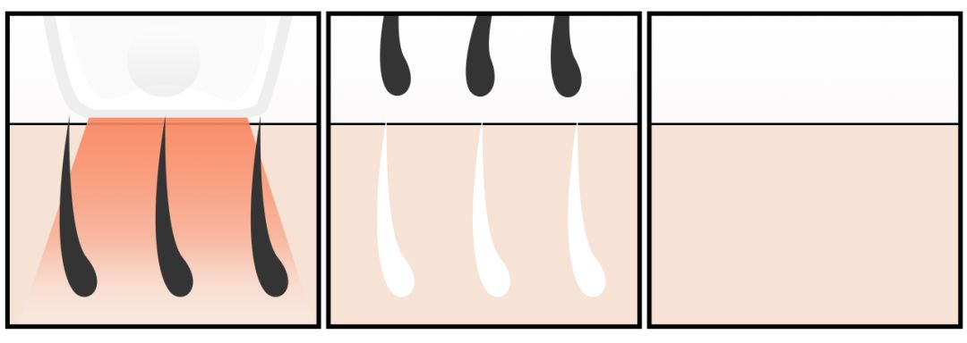网红脱毛仪器家用评测,网红脱毛仪哪个好用又便宜