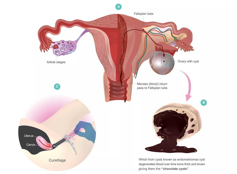 卵巢巧克力囊肿容易复发吗,卵巢巧克力囊肿容易恶化吗