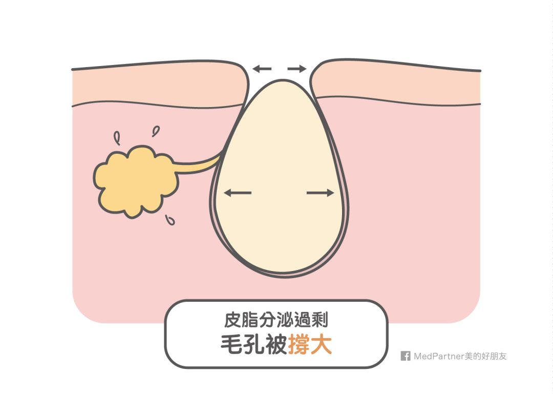 控油清洁毛孔,清洁控油收缩毛孔步骤