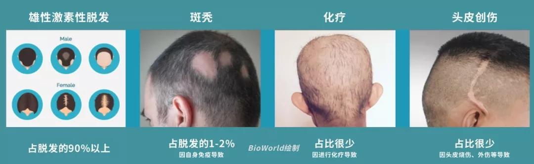 非那雄胺治疗年轻男性脱发，或可产生自杀倾向