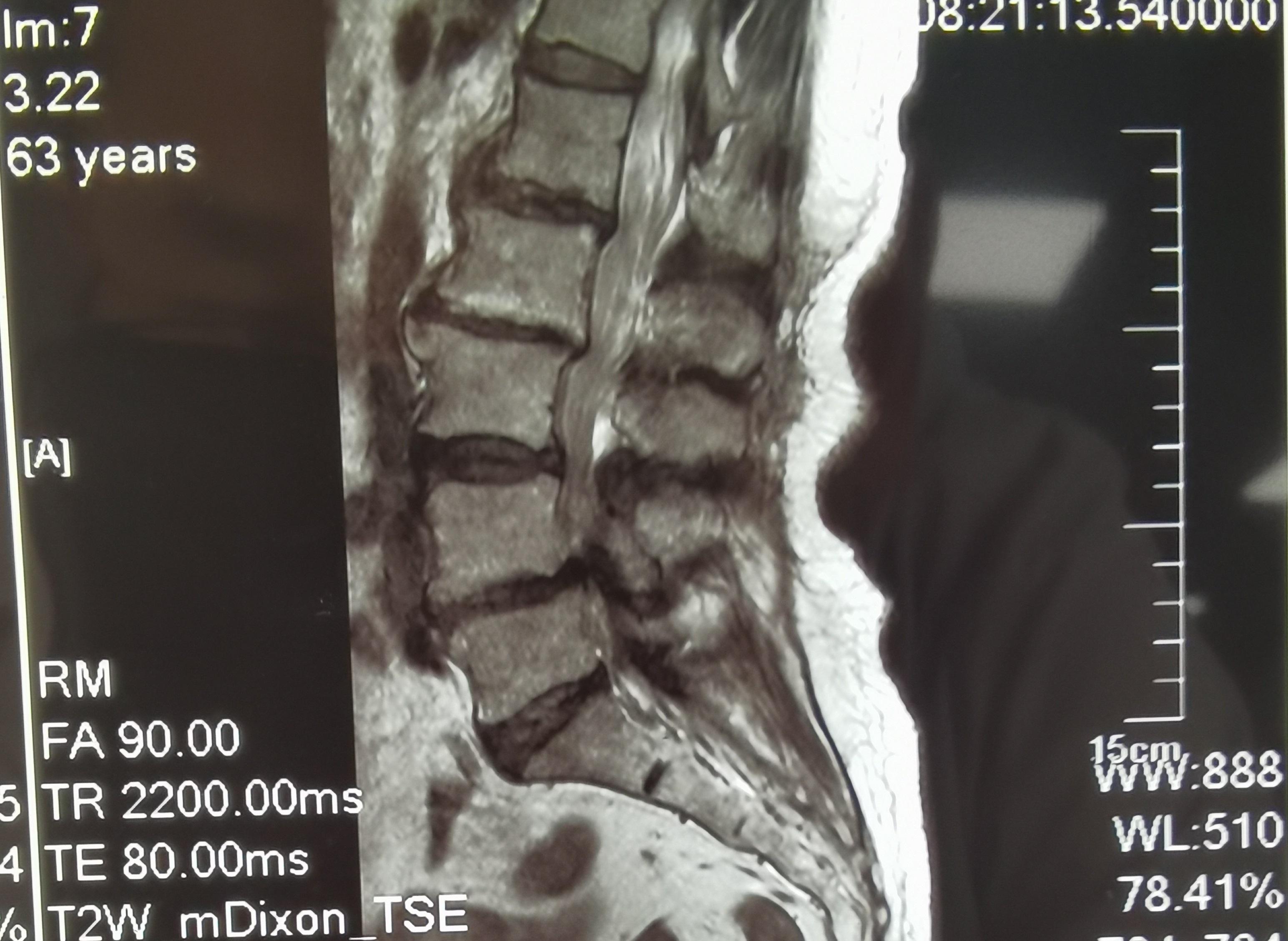 走路小腿酸痛发麻是怎么回事,走路多了下肢发麻