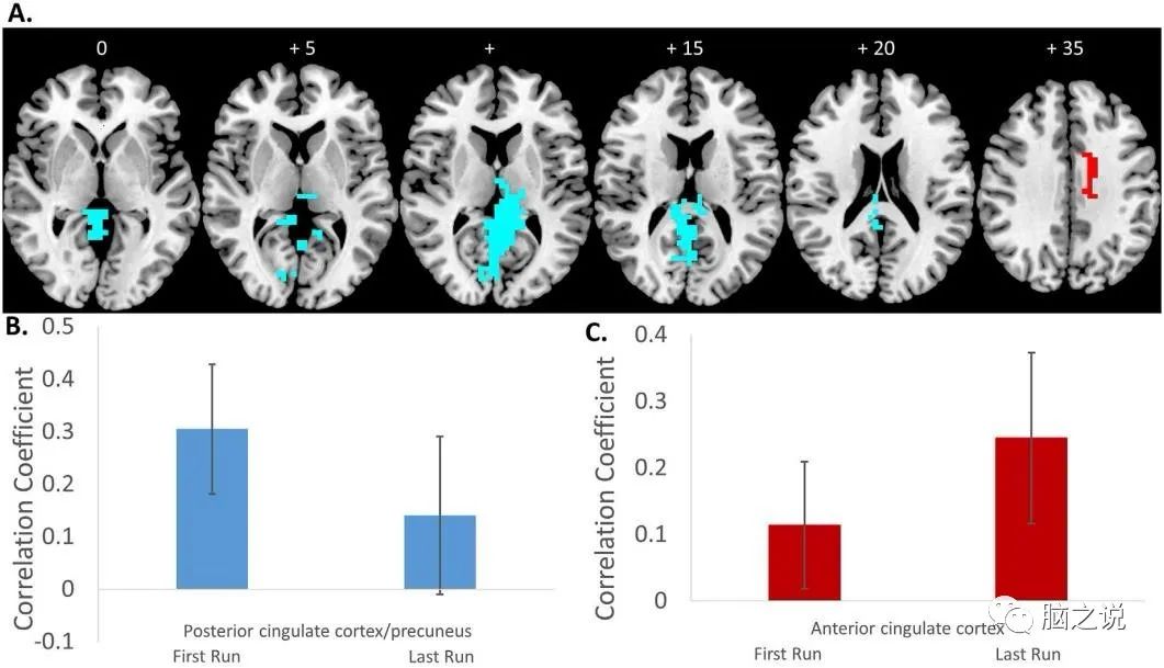 ADHD右侧额下回皮层fMRI神经反馈的功能连接变化
