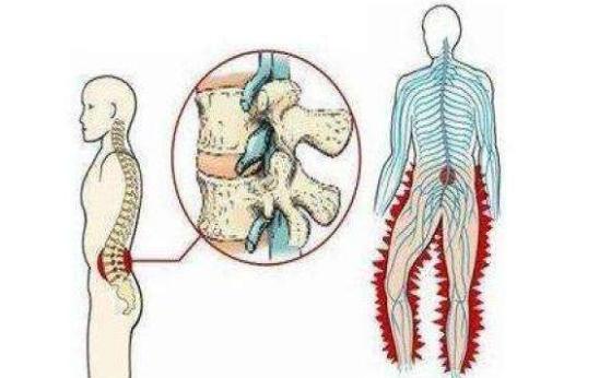 得了腰椎间盘突出原来可以这么治,腰椎间盘突出不要忽略的治疗方法