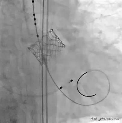 球囊扩张主动脉瓣膜,心脏球囊扩张瓣膜