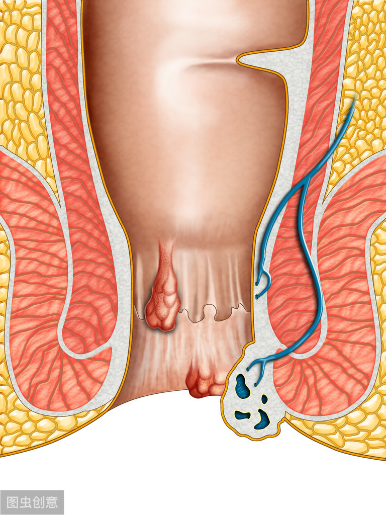 哪种手术治疗痔疮不复发,中医不手术如何治疗痔疮