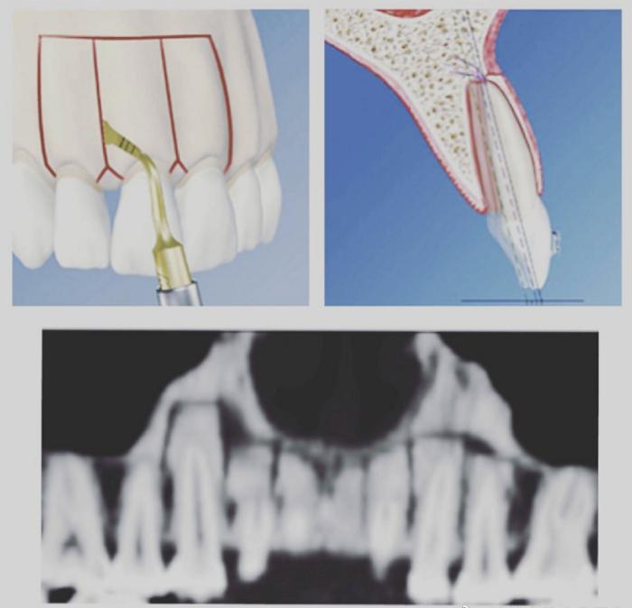 骨性龅牙怎么弄,如何判断骨性龅牙的轻重程度