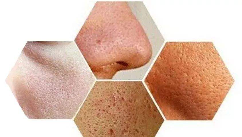 「丽皙白美肤」收下这份黑头作战攻略，让你摆脱尴尬草莓鼻！