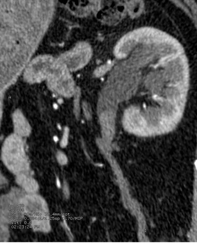 尿路造影输尿管间断显影,静脉尿路造影和排泄性尿路造影