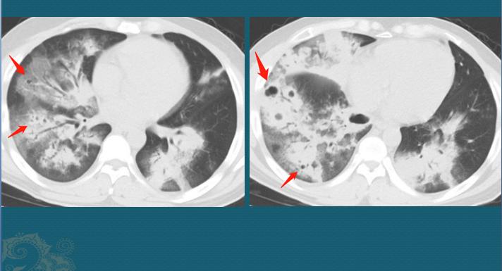 流感合并细菌感染时有什么症状,流感合并细菌感染可以治好吗