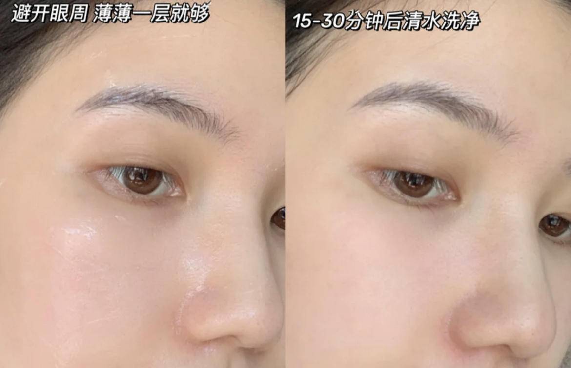 脸上有个光滑不痛不痒的小疙瘩,脸上皮肤粗糙长疙瘩是怎么回事