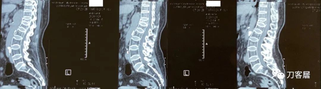脊柱骨质疏松性压缩性骨折,老年骨质疏松压缩性骨折诊治