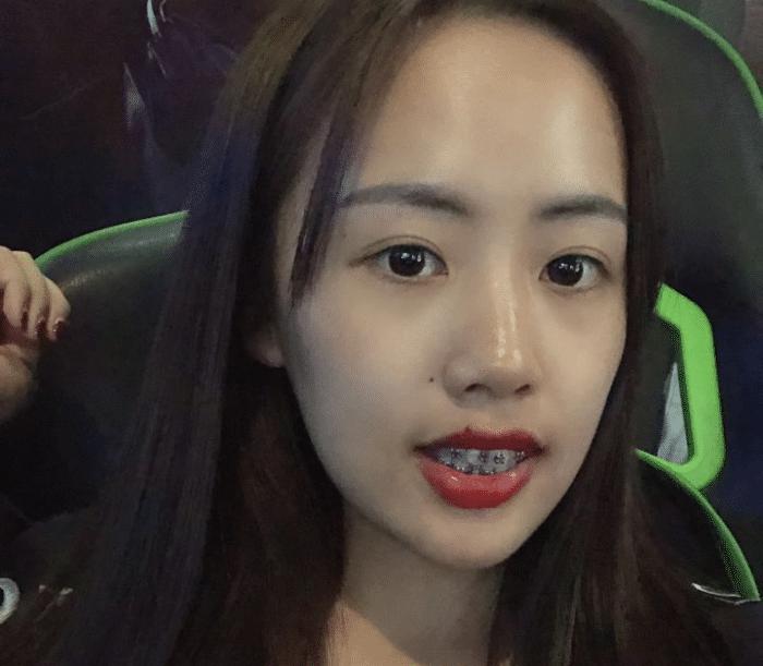 牙套隐形日记,牙套日记正颌