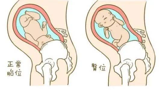 生产使用产钳算难产吗,哪些情况可能难产