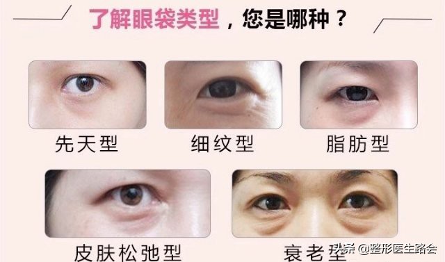 泪沟都到脸颊了怎么办,泪沟眼袋越来越严重怎么办