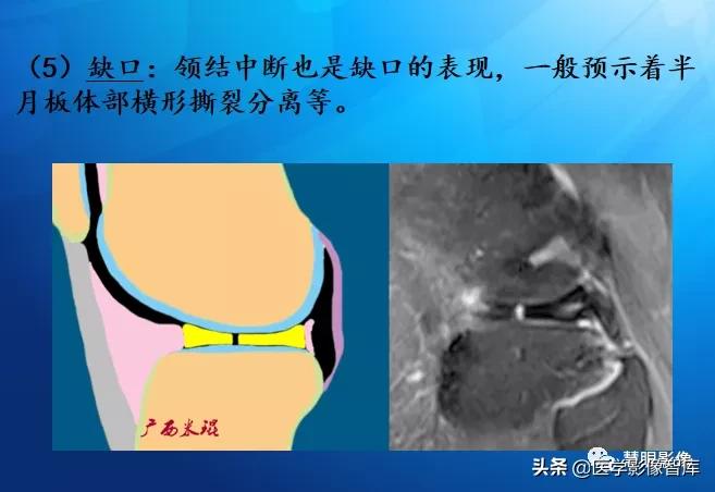 膝关节半月板损伤的解剖结构图,半月板mri解剖图解