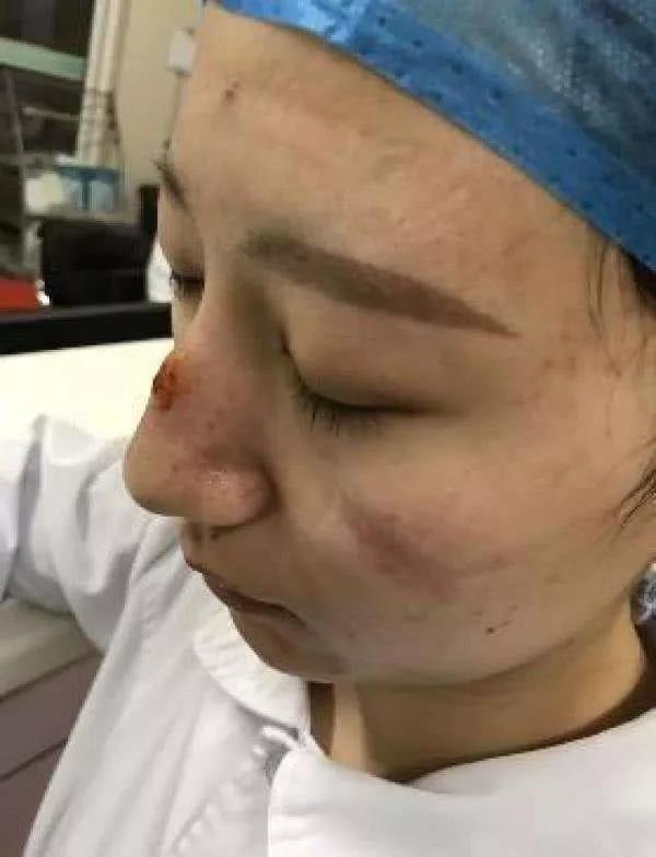 戴口罩脸上痘痘怎么快速消除,戴口罩长痘如何正确护理