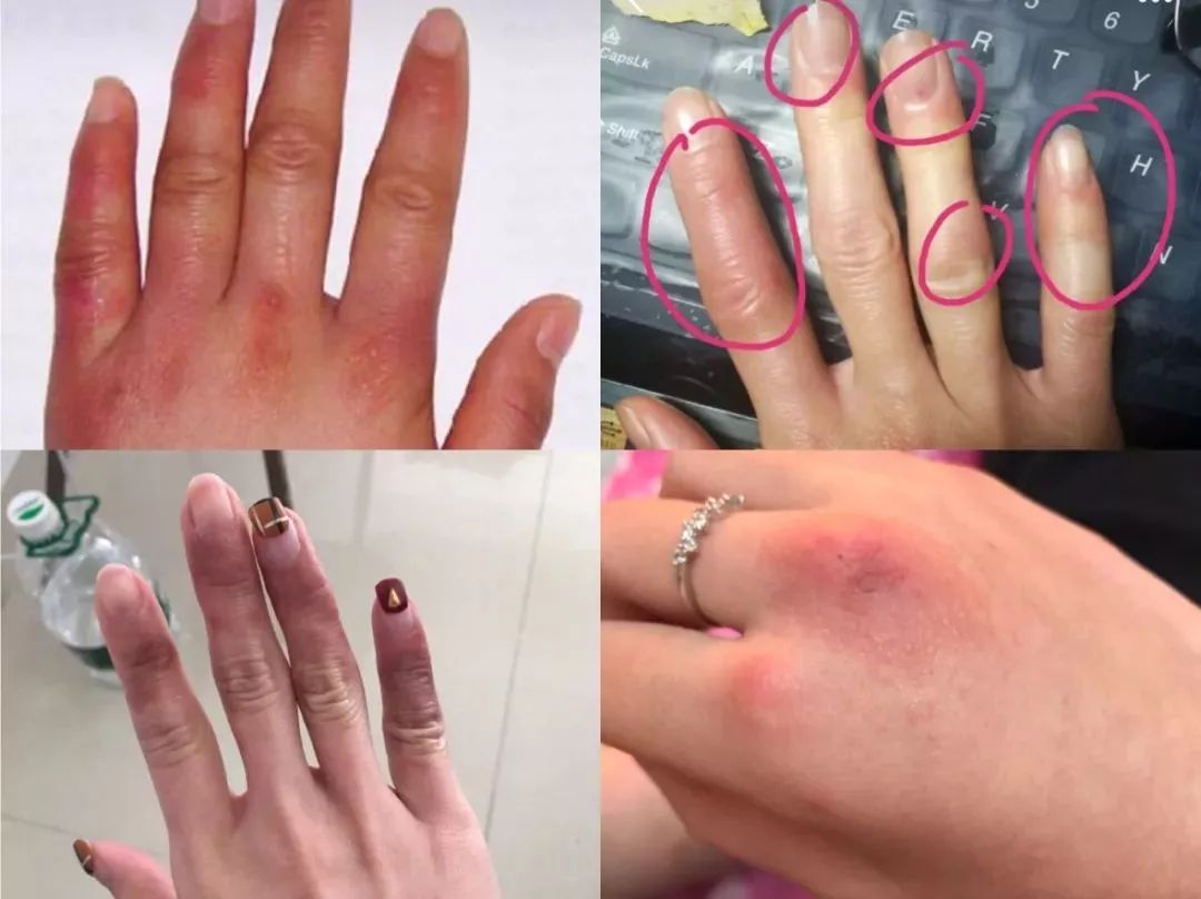 冬天脚跟干裂又起皮怎么办,冬天脚跟干裂起硬皮擦什么保湿好