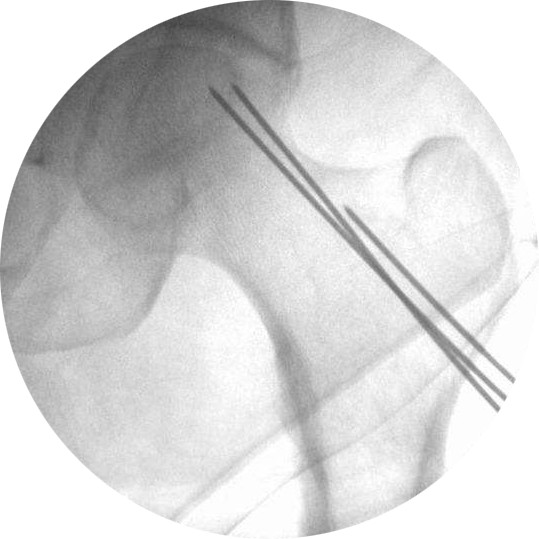 得了股骨头坏死又没钱治怎么办,股骨头坏死无药可治