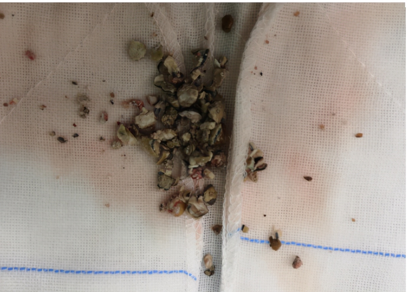 输尿管结石吃七种食物最好,输尿管结石禁吃食物