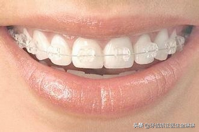 各种牙套的弊端,各种牙套的优缺点是什么