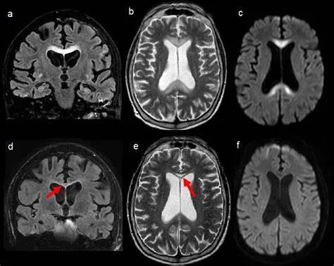 胼胝体有什么症状,胼胝体形态较小可以治疗吗