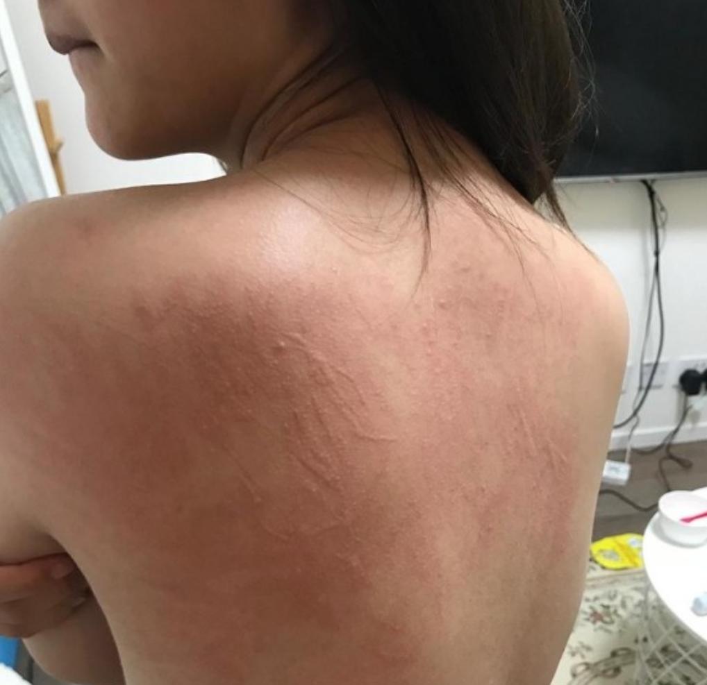 宅男女神邓月平戒口吃“草”曾荷尔蒙失调惹湿疹满身抓痕