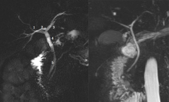 胆囊变异解剖图,胆道血供解剖