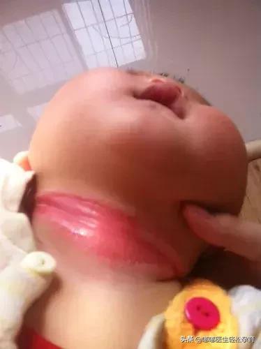 新生儿淹脖子破皮解决方案,婴幼儿脖子淹了破皮了怎么办