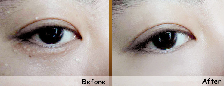 手动去脂肪粒工具,去脂肪粒神器排行榜