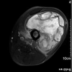胚胎横纹肌肉瘤是怎么形成的,横纹肌肉瘤转移全身能活多久
