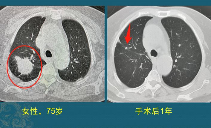 吃什么抗肺癌防癌最好,老年人肺癌晚期治疗成功案例