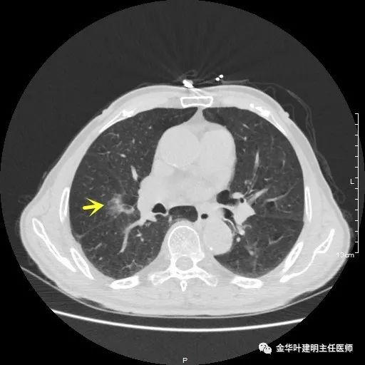 多发原发肺癌能根治吗,肺部原发性恶性肿瘤好治