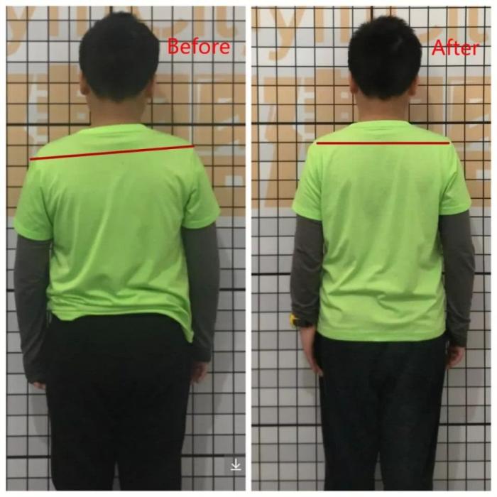 常见的体态问题--高低肩的处理方法