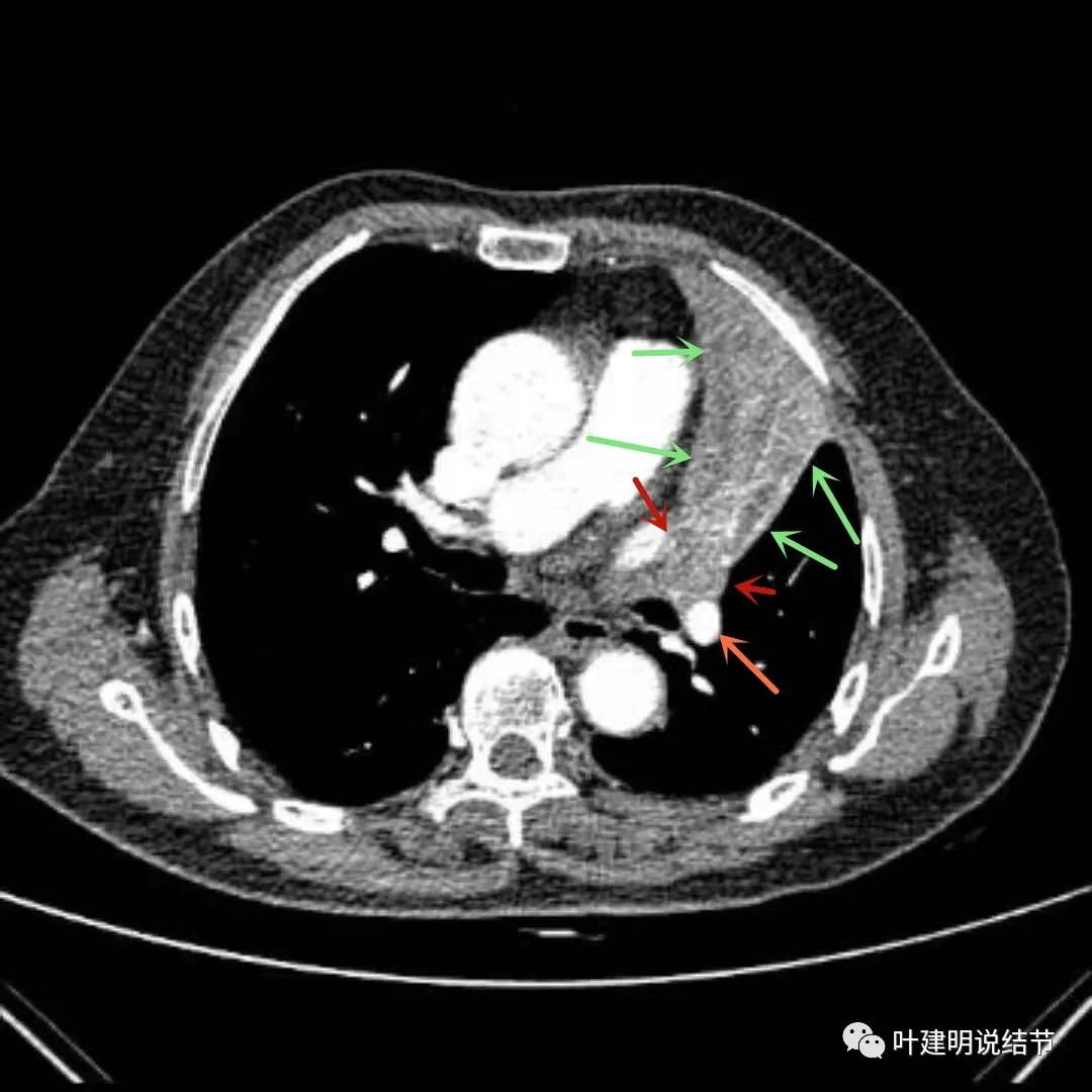 高龄肺癌靶向治疗效果,高龄老人肺癌早期适合放疗吗