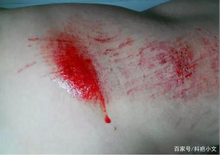 孩子不小心受伤了怎样问老师,孩子不小心摔伤怎么处理