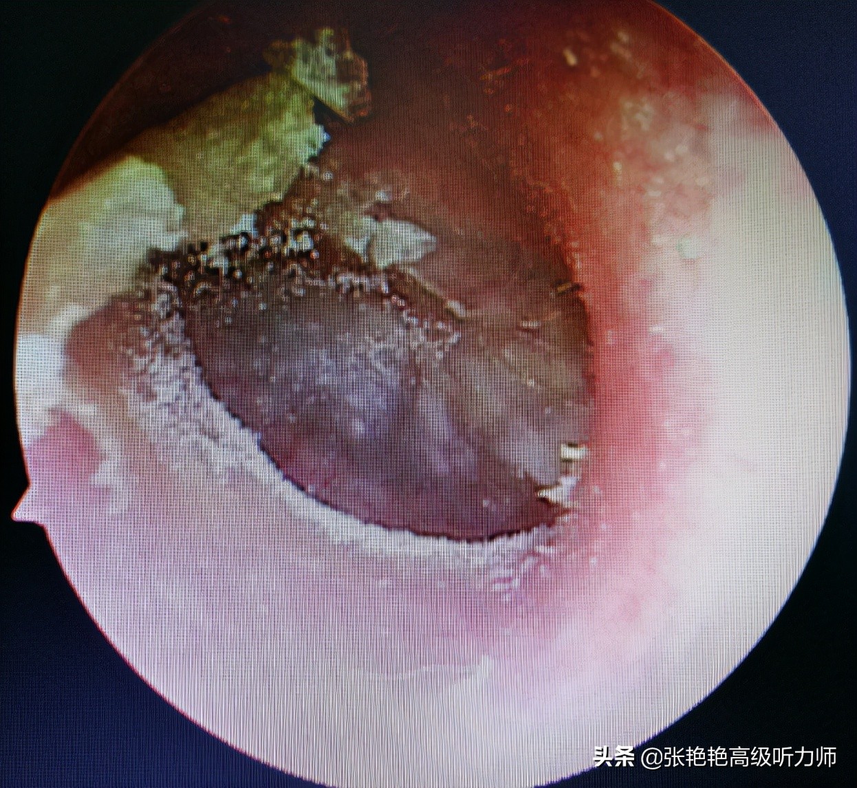 各种常见听力损失,哪种类型的听力损伤具有稳定性